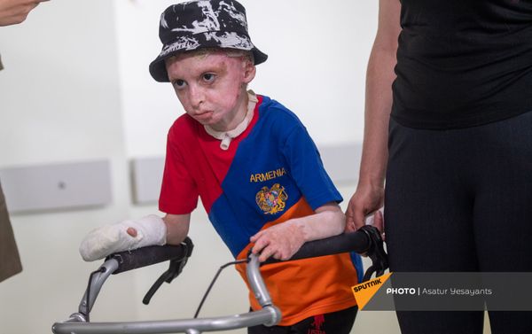 8-летний Ваге Мосинян, получивший 80% ожогов в дорожно-транспортном происшествии, выписывается из больницы через год - Sputnik Армения
