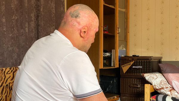 Потерпевший при взрыве на складе горючего в Степанакерте Араик Бабаян - Sputnik Армения
